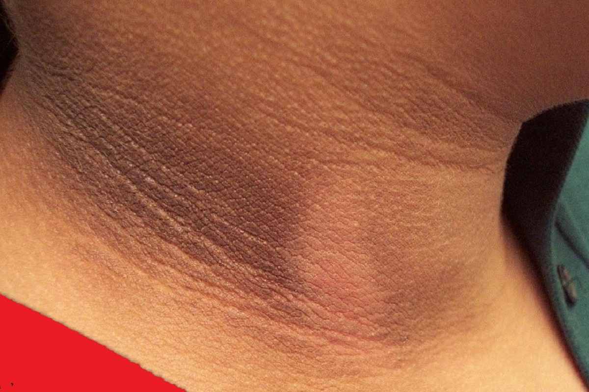 Home Remedy Remove Dark Neck