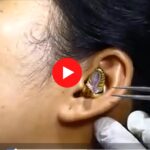 Snake Entered Girl's Ear
